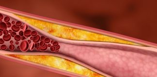 Aterosclerosis: causas, síntomas, tratamientos y más