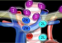 ¿Qué son los ganglios linfáticos mediastinales?