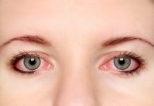 Conjuntivitis: sus causas, síntomas, tratamientos, prevención y más