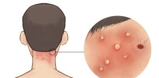 Foliculitis: causas, tratamientos, prevención y más