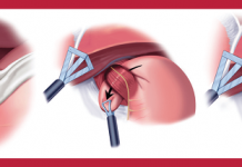 Cirugía antirreflujo: beneficios, posibles complicaciones, alternativas y más