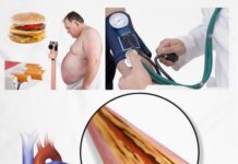 Hipertensión arterial: causas, síntomas y tratamientos