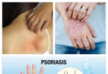 Tipos de psoriasis: desde la más común a la más difícil de tratar